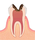 虫歯進行度合いC3