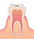 虫歯進行度合いC1