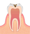 虫歯進行度合いC2