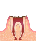 虫歯進行度合いC4